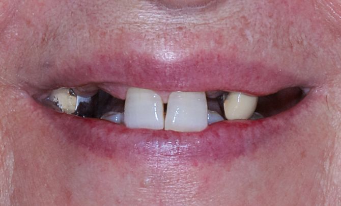 Case 1 Dental Implant before