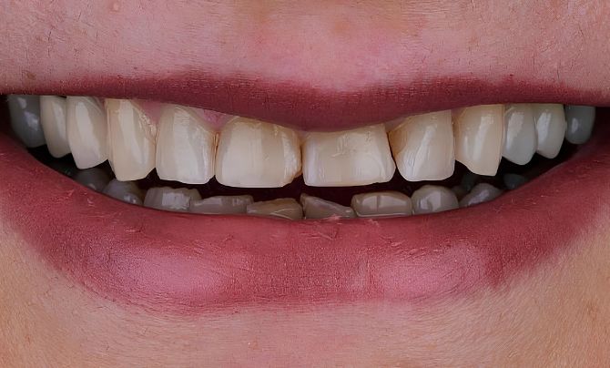 Case 1 Smile Makeover before