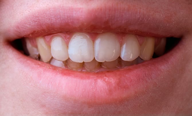 Case 1 Teeth straightening a