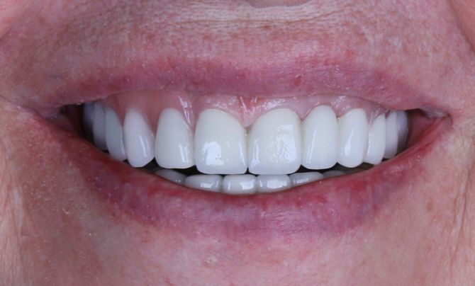 Case 1 Dental Implant after