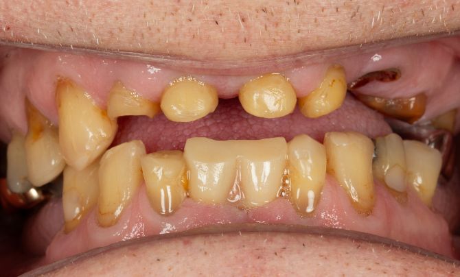 Overdenture before 1