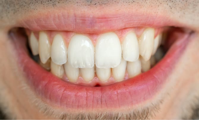 Case 2 Teeth straightening a