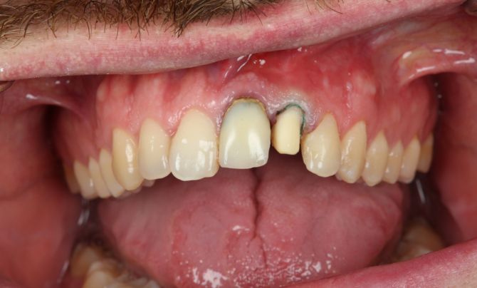 Anterior crown before