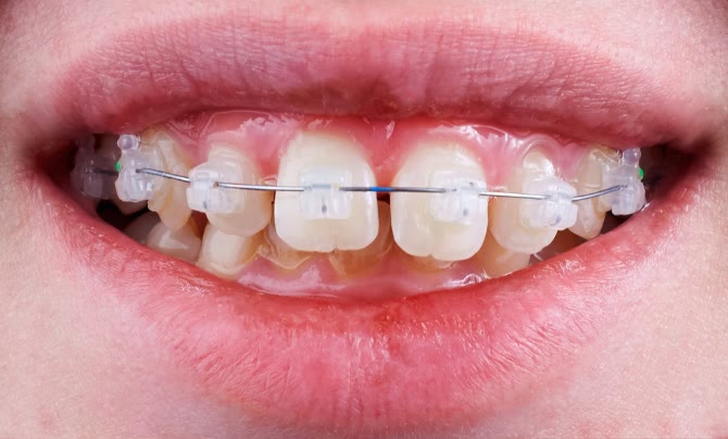 Case 1 Teeth straightening b