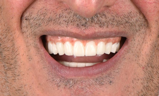 Case 2 Dental Implants_teeth after