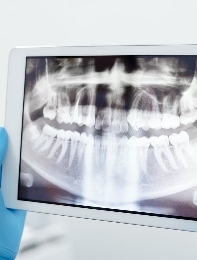 Cavity Prevention