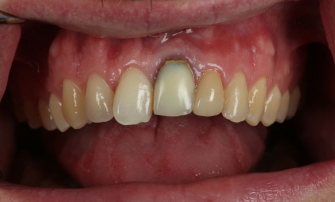 Anterior crown after