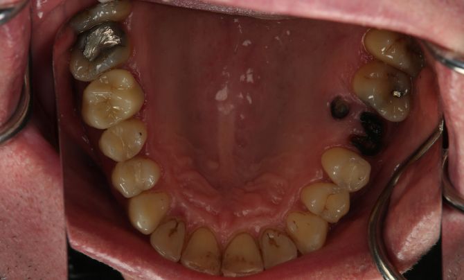 Posterior crown after