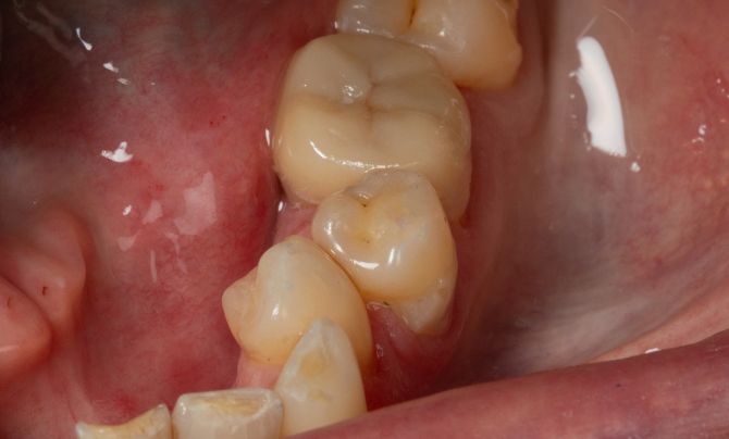 Broken amalgam onlay after