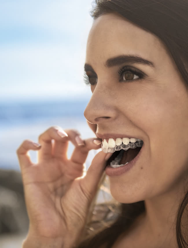 Aligners