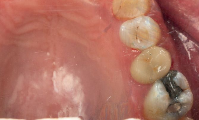 Case 1 Amalgam replacement onlay after