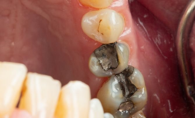 Case 1 Amalgam replacement onlay before