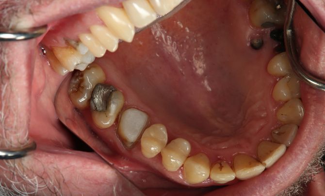 Posterior crown before