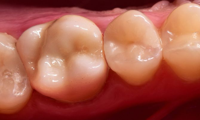 Case 1 Crowns after