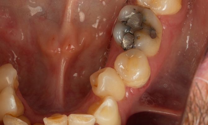 Broken amalgam onlay before