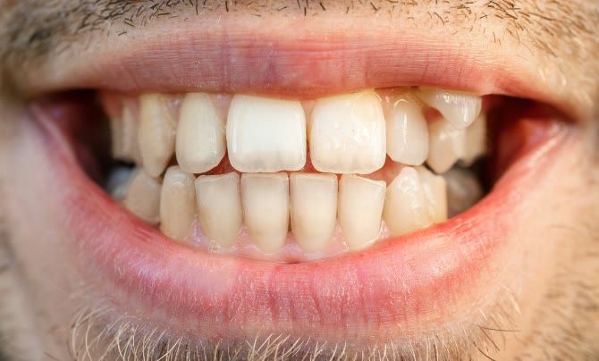 Case 2 Teeth straightening b