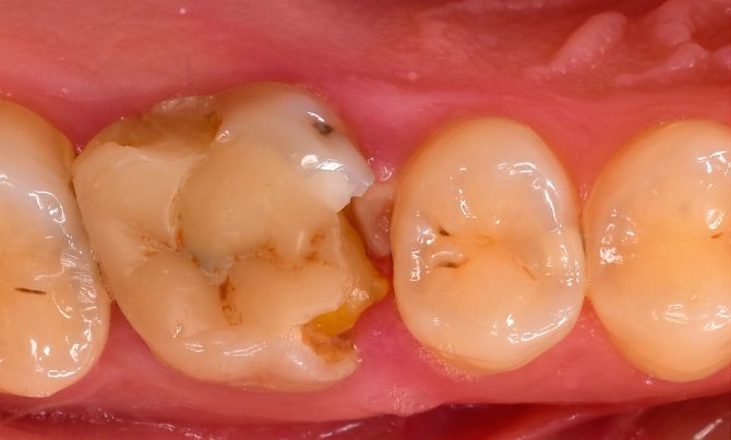 Case 1 Crowns before