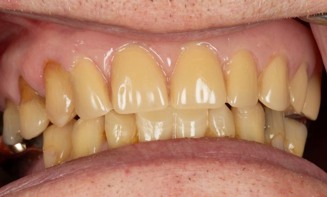 Overdenture after