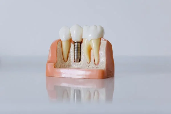 Make Crowns on Front Teeth Last Longer