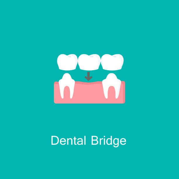 What Is a Bridge for Teeth? The Complete Guide to Restoring Your Smile